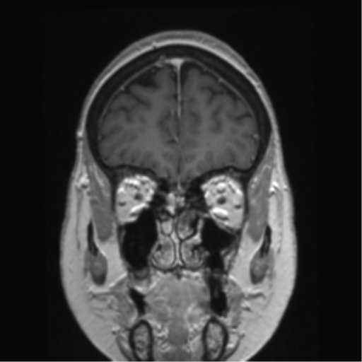 Anterior temporal pole cysts (Radiopaedia 46629-51102 Coronal T1 C+ 138).png