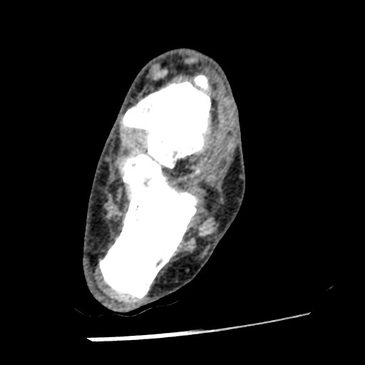 File:Anterior tibial artery false aneurysm (Radiopaedia 88984-105809 A 166).jpg