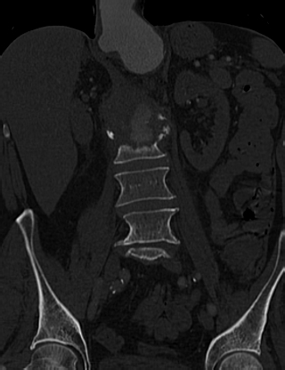 File:Anterior vertebral scalloping (abdominal aortic aneurysm) (Radiopaedia 66744-76067 Coronal bone window 28).jpg