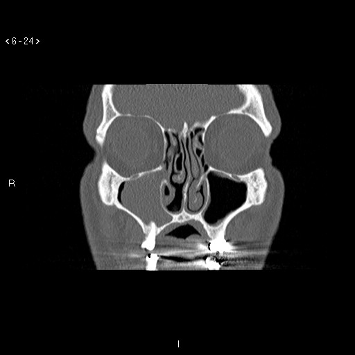 File:Antrochoanal Polyp (Radiopaedia 70510-80631 Coronal bone window 13).jpg