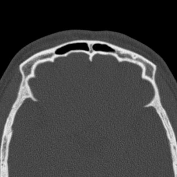 Antrochoanal polyp (Radiopaedia 33984-35202 Axial bone window 72).jpg