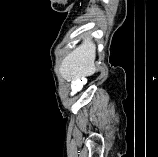 File:Aortic aneurysm and Lemmel syndrome (Radiopaedia 86499-102554 D 4).jpg