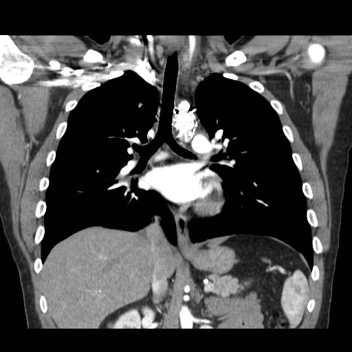 File:Aortic arch stent (Radiopaedia 30030-30595 F 15).jpg