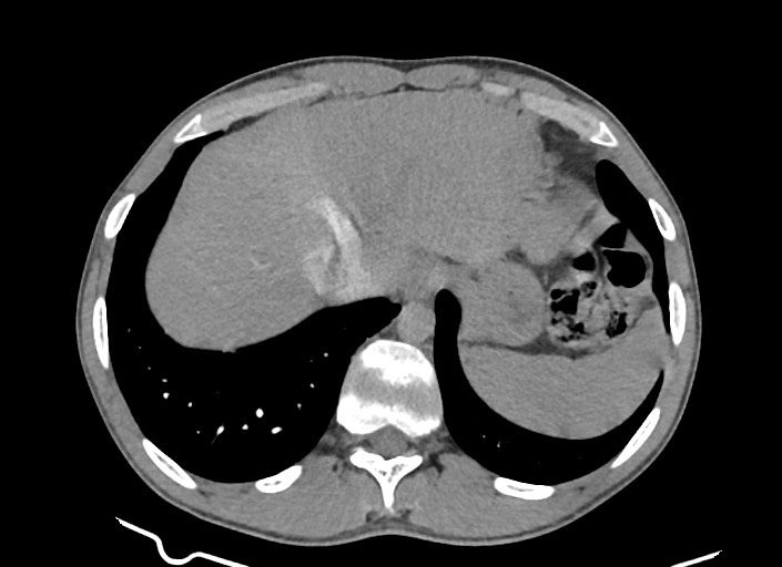 File:Aortic coarctation with aneurysm (Radiopaedia 74818-85828 A 48).jpg