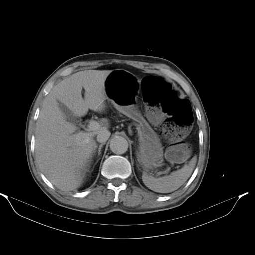 Aortic dissection- Stanford type A (Radiopaedia 22085-22085 Axial C+ delayed 13).jpg
