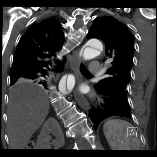 Aortic dissection (CTPA) (Radiopaedia 75506-86750 B 48).jpg