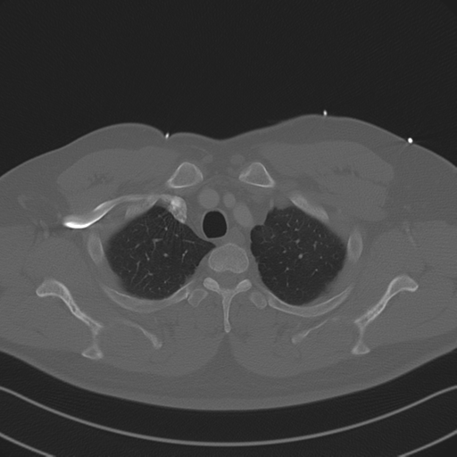 Aortic dissection (Radiopaedia 50763-56234 Axial bone window 22).png