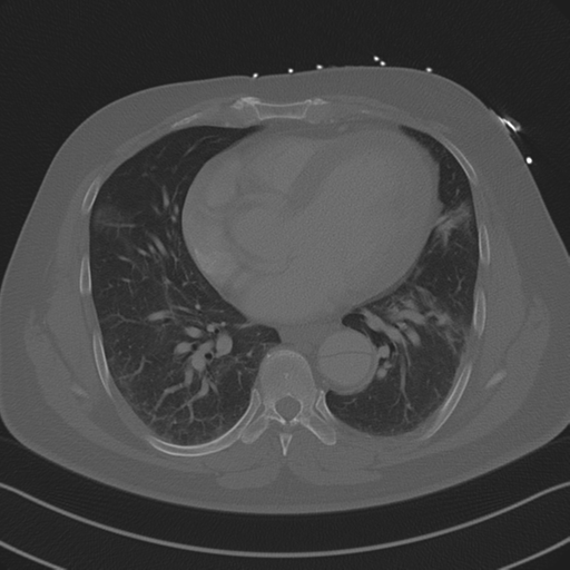 Aortic dissection (Radiopaedia 50763-56234 Axial bone window 65).png