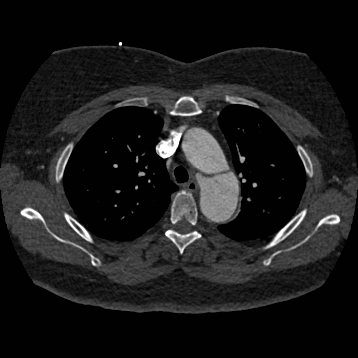 File:Aortic dissection (Radiopaedia 57969-64959 A 100).jpg