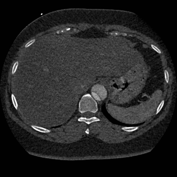 File:Aortic dissection (Radiopaedia 57969-64959 A 278).jpg