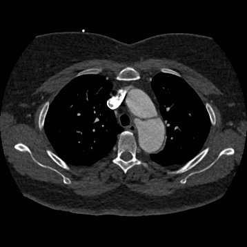 File:Aortic dissection (Radiopaedia 57969-64959 A 98).jpg