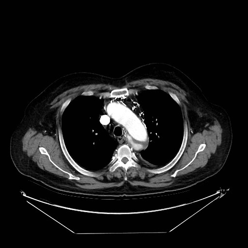 Aortic dissection (Radiopaedia 62562-71000 A 7).jpg
