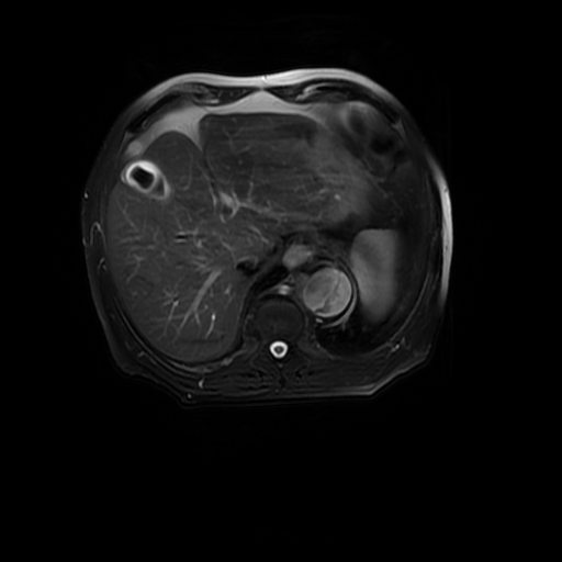 File:Aortic dissection - Stanford A - DeBakey I (Radiopaedia 23469-23551 Axial T2 fat sat 16).jpg