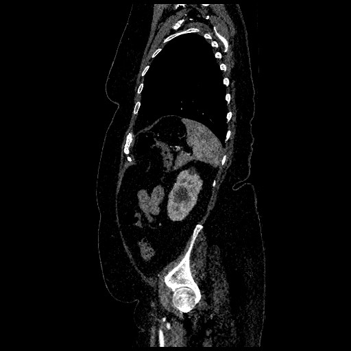 File:Aortic dissection - Stanford type B (Radiopaedia 88281-104910 C 71).jpg