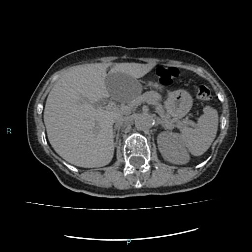 File:Aortic dissection extended to lusory artery (Radiopaedia 43686-47136 Axial non-contrast 30).jpg