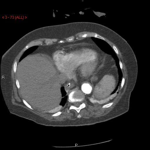 File:Aortic intramural hematoma (Radiopaedia 27746-28001 A 73).jpg