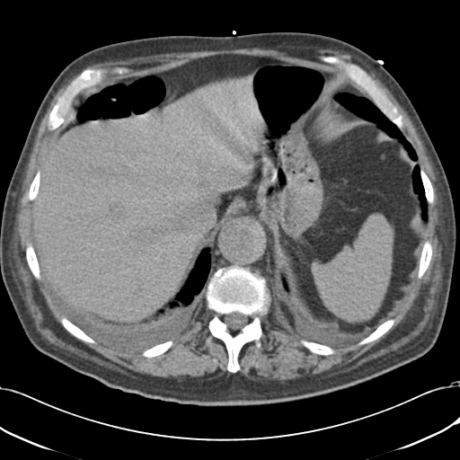 File:Aortic intramural hematoma (Radiopaedia 34260-35540 Axial non-contrast 54).png