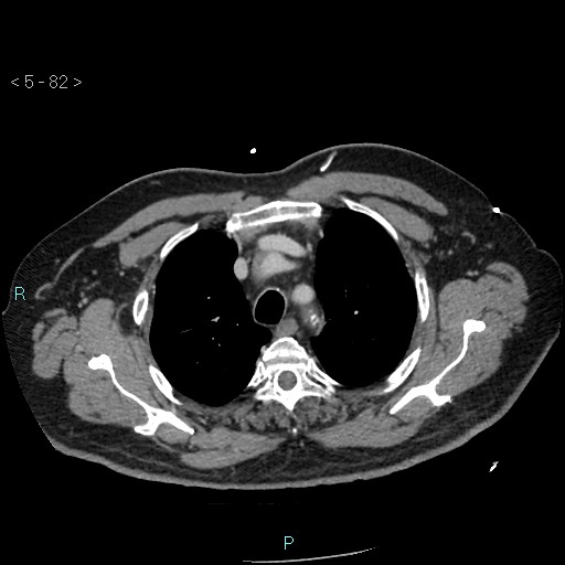Aortic intramural hematoma (Radiopaedia 48463-53380 C 38).jpg