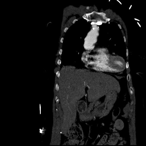 File:Aortic intramural hematoma from penetrating atherosclerotic ulcer (Radiopaedia 31137-31836 C 15).jpg