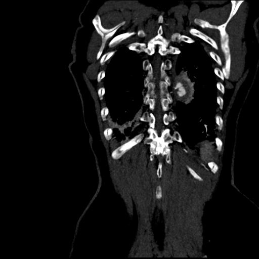 File:Aortic intramural hematoma from penetrating atherosclerotic ulcer (Radiopaedia 31137-31836 C 59).jpg