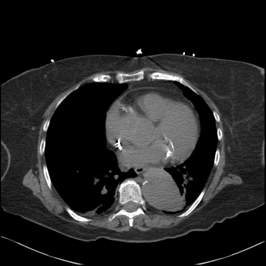 Aortic intramural hematoma with dissection and intramural blood pool (Radiopaedia 77373-89491 Axial non-contrast 59).jpg