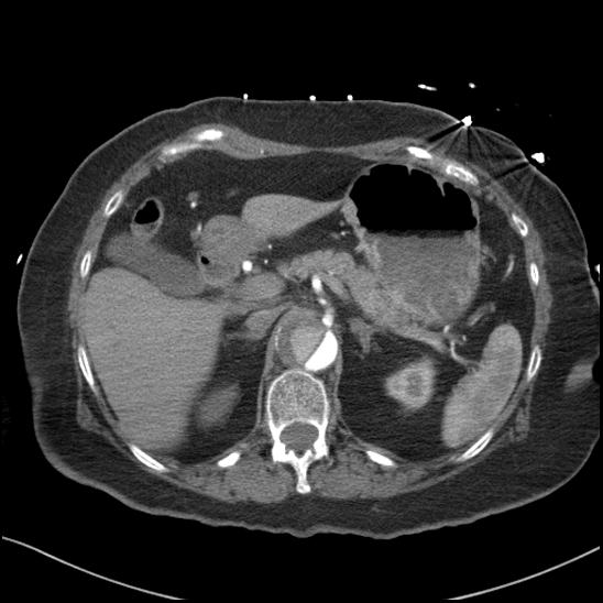 Aortic intramural hematoma with dissection and intramural blood pool (Radiopaedia 77373-89491 B 111).jpg