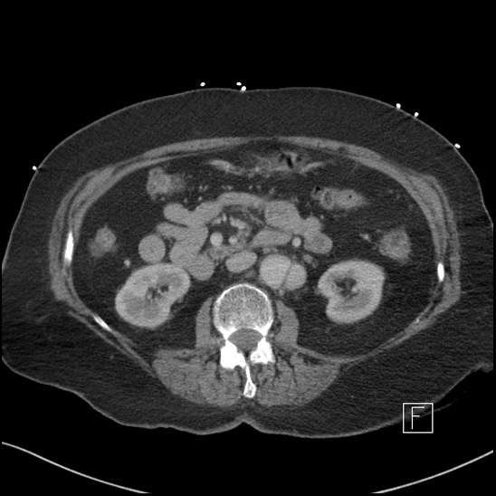Aortic intramural hematoma with dissection and intramural blood pool (Radiopaedia 77373-89491 E 33).jpg
