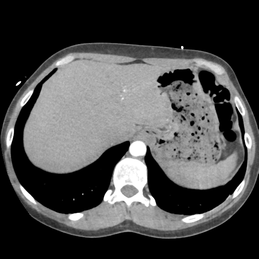 File:Aortic valve non-coronary cusp thrombus (Radiopaedia 55661-62189 B 46).png