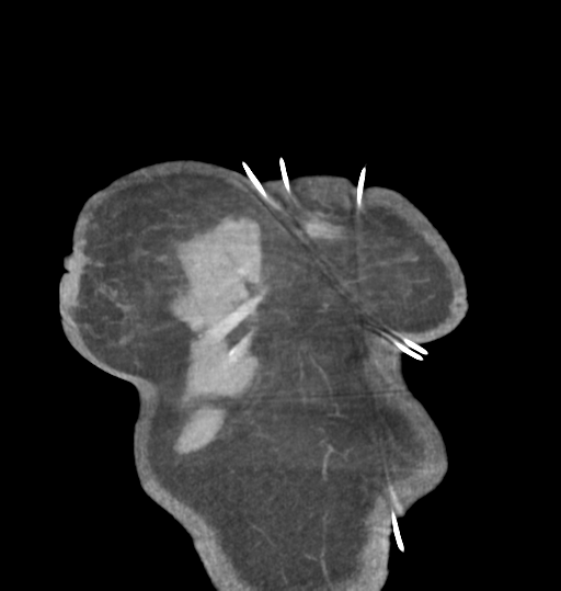 File:Aortic valve non-coronary cusp thrombus (Radiopaedia 55661-62189 C 6).png