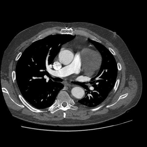 File:Aorto-coronary bypass graft aneurysms (Radiopaedia 40562-43157 A 50).png