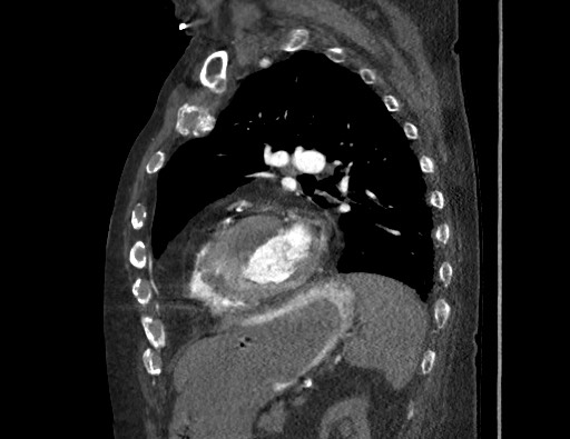 Aortoesophageal fistula with endovascular repair (Radiopaedia 73781-84592 Sagittal C+ CTPA 132).jpg