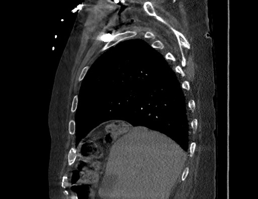 Aortoesophageal fistula with endovascular repair (Radiopaedia 73781-84592 Sagittal C+ CTPA 37).jpg