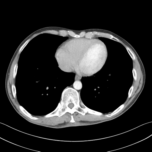 File:Apical pleural calcification (Radiopaedia 46141-50499 Axial C+ delayed 50).png