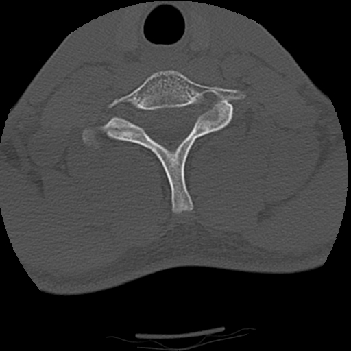 Apical pneumothorax on cervical spine CT (Radiopaedia 45343-49368 Axial bone window 70).jpg