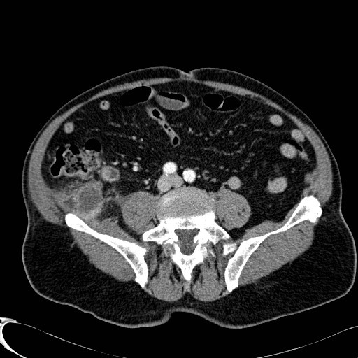 Appendiceal adenocarcinoma complicated by retroperitoneal abscess (Radiopaedia 58007-65039 B 90).jpg