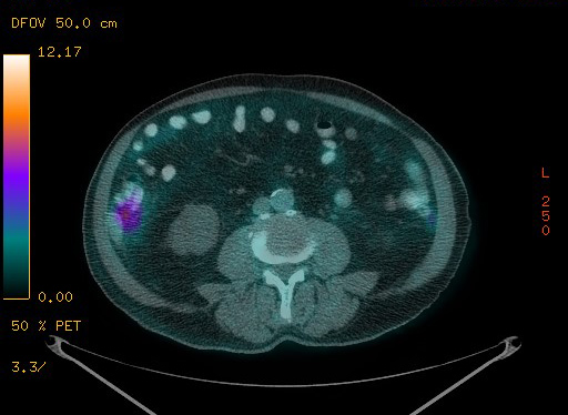 Appendiceal adenocarcinoma complicated by retroperitoneal abscess (Radiopaedia 58007-65041 Axial PET-CT 138).jpg