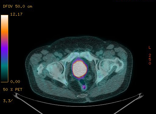 Appendiceal adenocarcinoma complicated by retroperitoneal abscess (Radiopaedia 58007-65041 Axial PET-CT 187).jpg