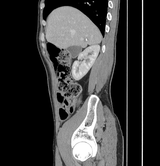 Appendiceal mucinous adenocarcinoma (Radiopaedia 66605-75922 C 16).jpg