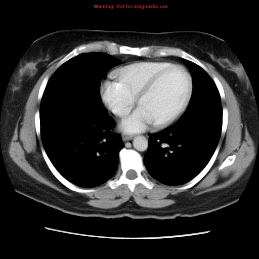 File:Appendiceal mucinous cystadenoma (Radiopaedia 8263-9111 Axial liver window 8).jpg