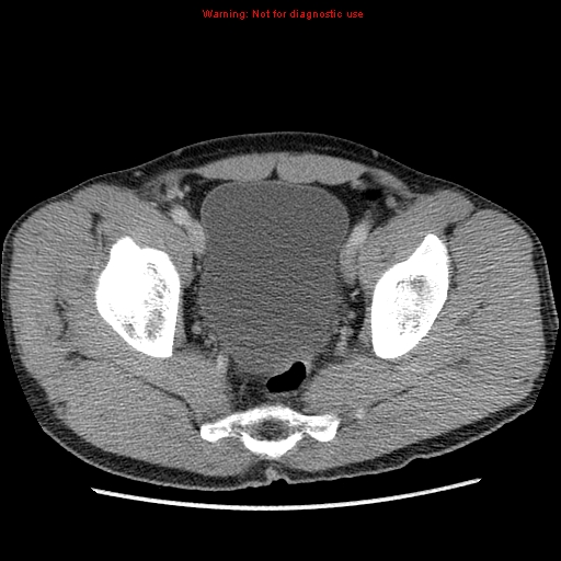 File:Appendicitis and renal cell carcinoma (Radiopaedia 17063-16760 A 50).jpg