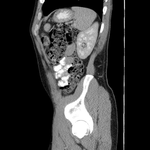Appendicitis complicated by post-operative collection (Radiopaedia 35595-37114 C 56).jpg