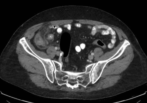 File:Appendicitis due to chicken fibula (Radiopaedia 74314-85198 A 27).jpg