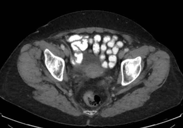 Appendicitis due to chicken fibula (Radiopaedia 74314-85198 A 48).jpg