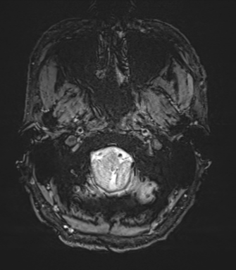Arachnoid cyst with subdural hematoma (Radiopaedia 85892-101743 Axial SWI 3).png