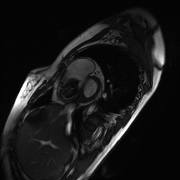 Arrhythmogenic right ventricular cardiomyopathy (Radiopaedia 87505-103850 short axis Cine SSFP 233).jpg