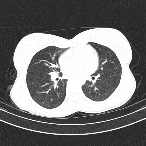 Arteria lusoria (Radiopaedia 88528-105192 Axial lung window 36).jpg