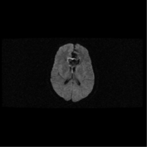 File:Arteriovenous malformation (cerebral) (Radiopaedia 40070-42580 Axial DWI 13).png