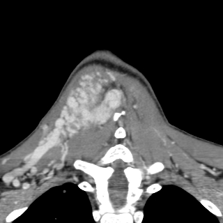 Arteriovenous malformation of the neck (Radiopaedia 53935-60062 D 45).jpg