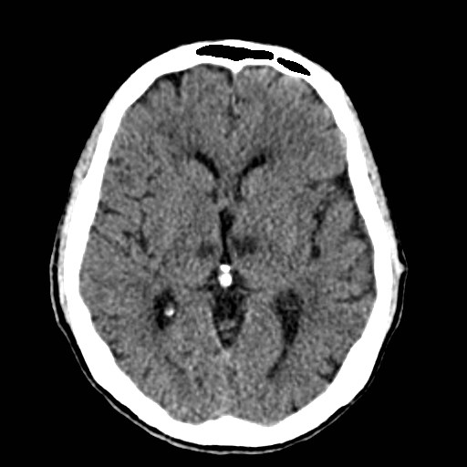 File:Artery of Percheron infarct (Radiopaedia 48088-52893 Axial non-contrast 21).jpg