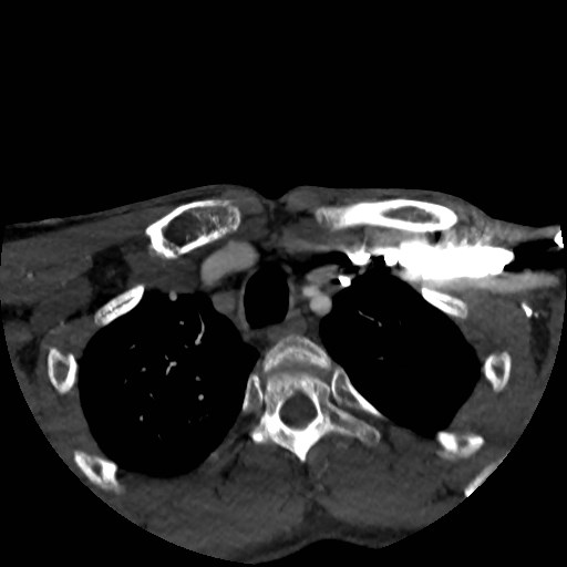 File:Artery of Percheron infarct (Radiopaedia 48088-52894 A 22).jpg